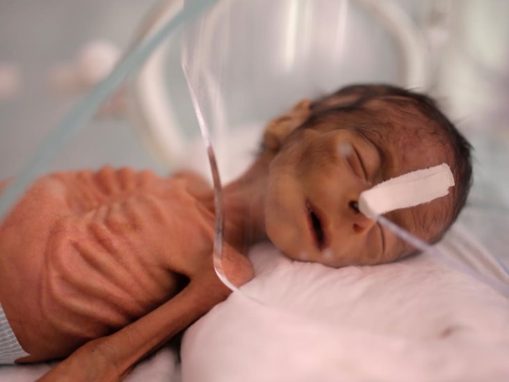 Prevén hambruna en Yemen Prevén hambruna en Yemen