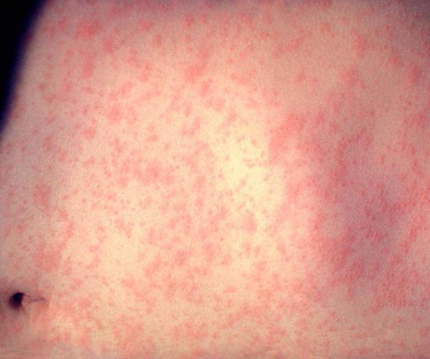 Declara Liberia un brote de sarampión en el país