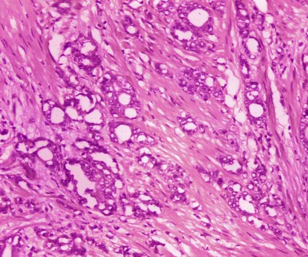 Esperan renombrar cáncer de próstata