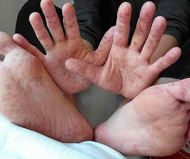 Alertan en Ribereña sobre la fiebre aftosa humana Alertan en Ribereña sobre la fiebre aftosa humana