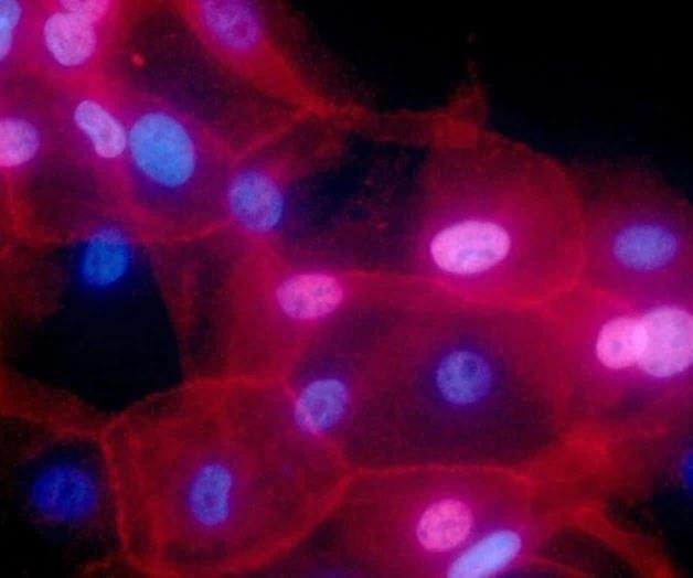 Fármaco logra remitir totalmente el cáncer rectal, revela estudio de EU