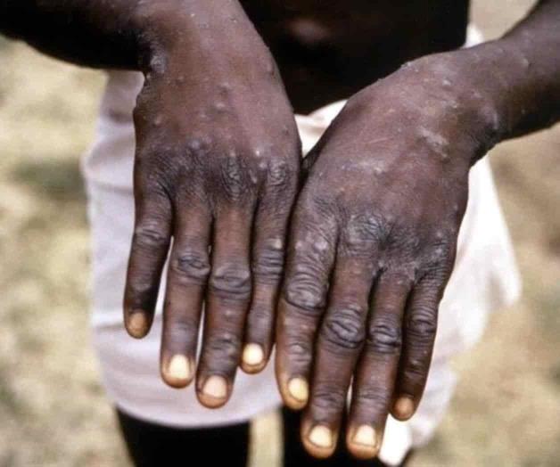 OMS descarta emergencia sanitaria por viruela símica