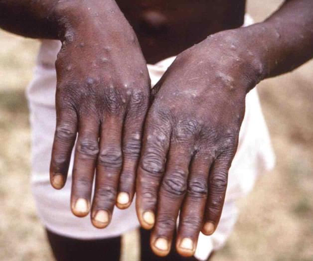 Viruela símica podría ser declarada una emergencia mundial