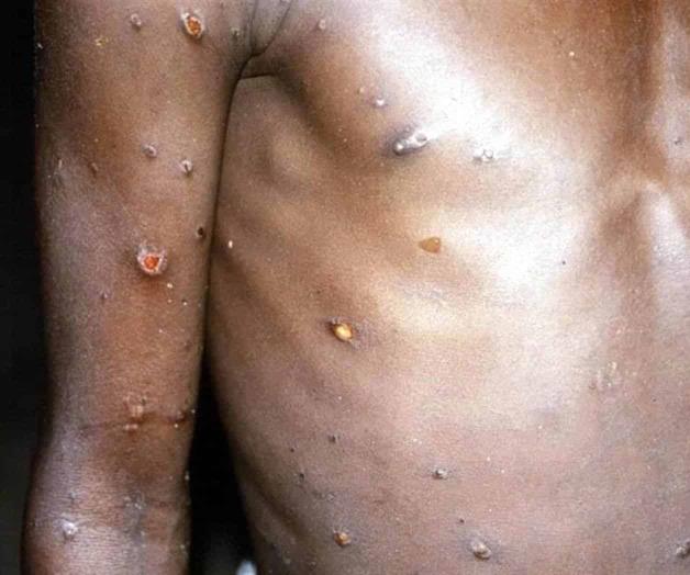 Amplían medidas en México por viruela de mono