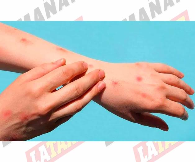 Sube a 91 el número de casos de viruela símica en México