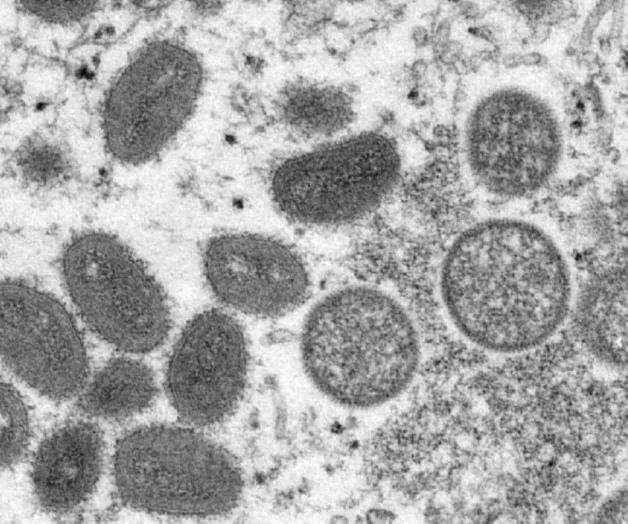 India confirma su primer fallecido por viruela del mono