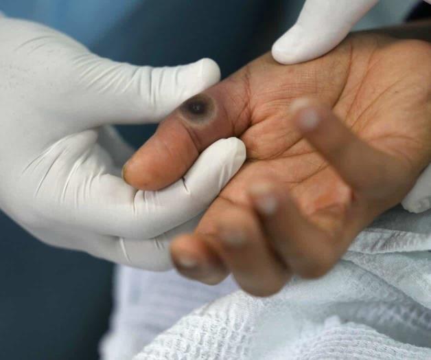 Hospital de Perú lucha contra rápido brote de viruela símica Hospital de Perú lucha contra rápido brote de viruela símica