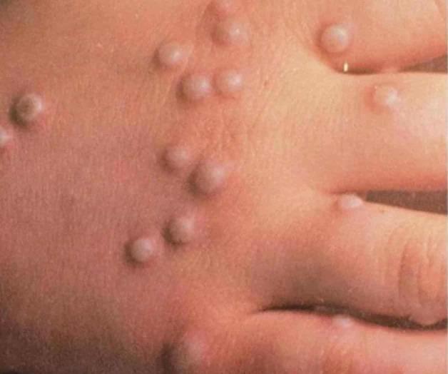 Confirman primer caso de viruela del mono en Hidalgo