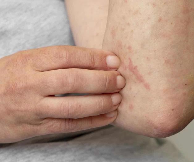 Suman 386 casos de viruela del mono en México Suman 386 casos de viruela del mono en México