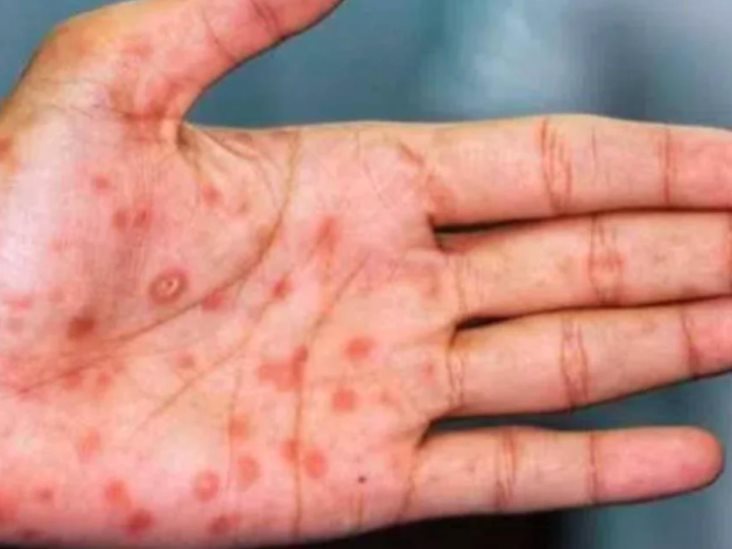 Zacatecas confirma primer caso de viruela del mono Zacatecas confirma primer caso de viruela del mono