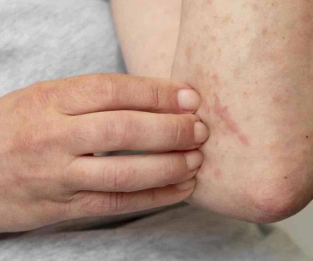 Escala viruela símica a 25 estados