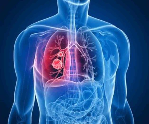 El cáncer de pulmón y sus desafíos El cáncer de pulmón y sus desafíos