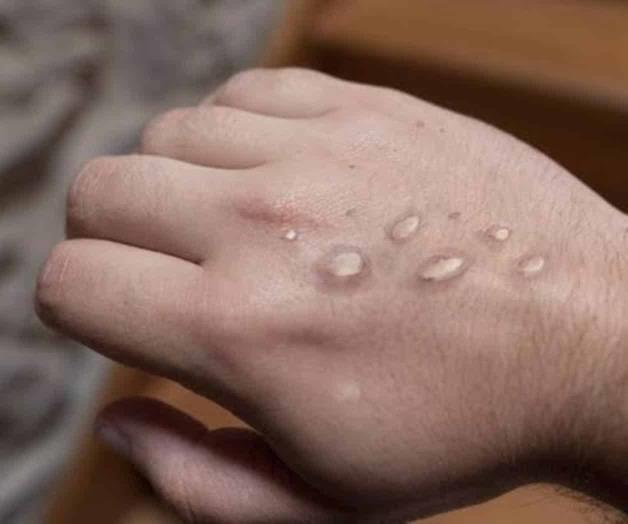 En cuarentena, caso de viruela del mono