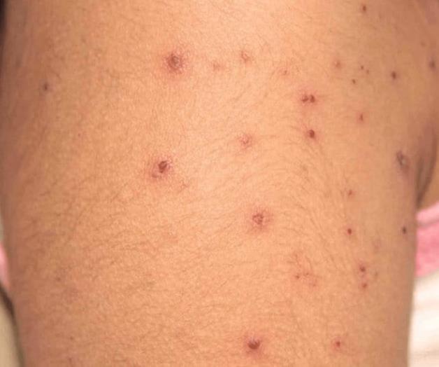 Casos de varicela aumentan en Tamaulipas, ¿quiénes son los más afectados?