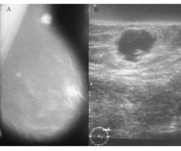 Advierte IMSS importancia  para detectar cáncer de mama