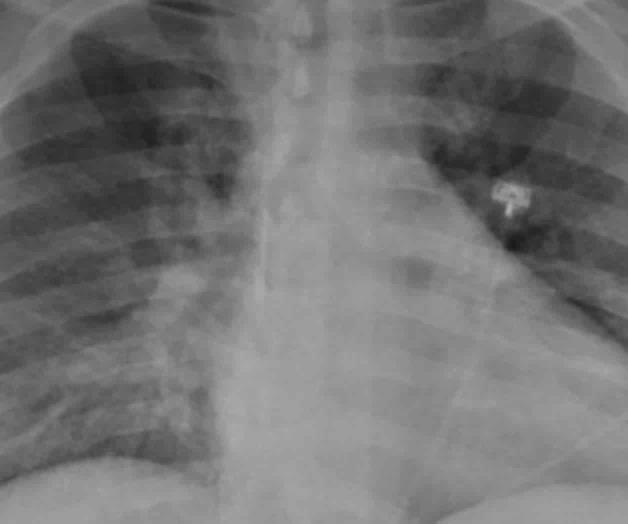 UNICEF denuncia que cada 45 segundos fallece un niño menor de cinco años por neumonía