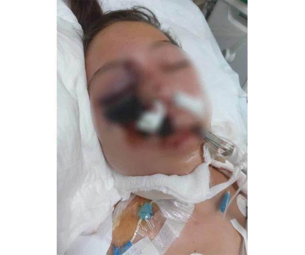 Requieren apoyo para joven infectada con “hongo negro” Requieren apoyo para joven infectada con “hongo negro”