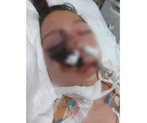 Muere joven contagiada por hongo negro Muere joven contagiada por hongo negro