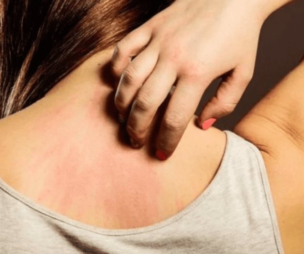 Pensó que era alergia al jabón y el diagnóstico fue devastador