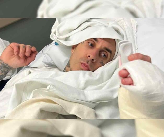 Travis Barker sube foto de la operación en su dedo 