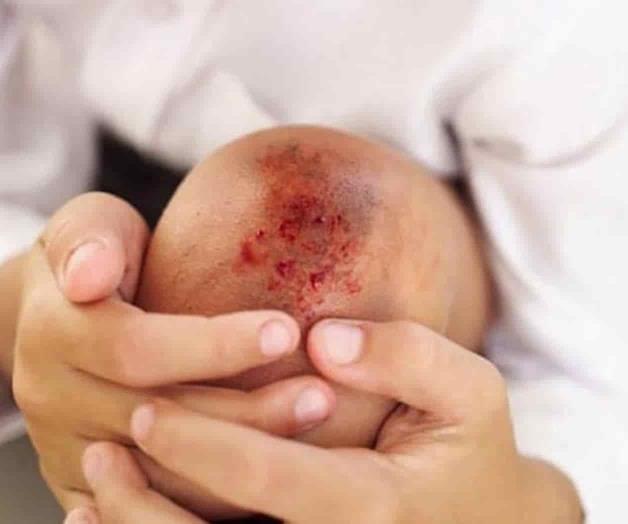 Celebran el Día de la Hemofilia Celebran el Día de la Hemofilia