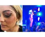 Bebe Rexha recibe puntos en la cara tras ser golpeada con un celular