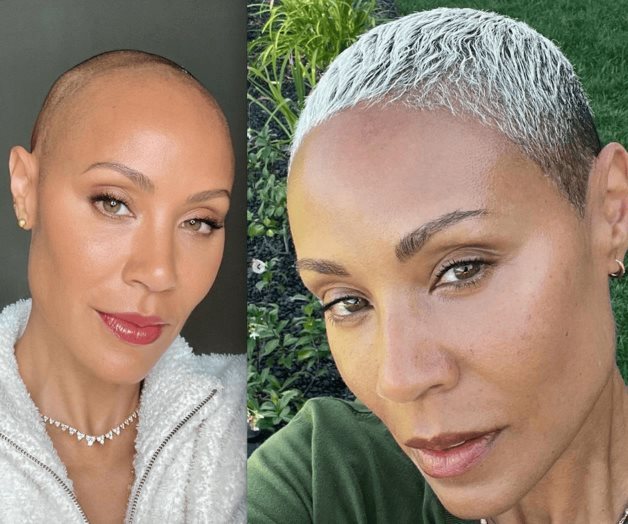 Muestra avances de su alopecia