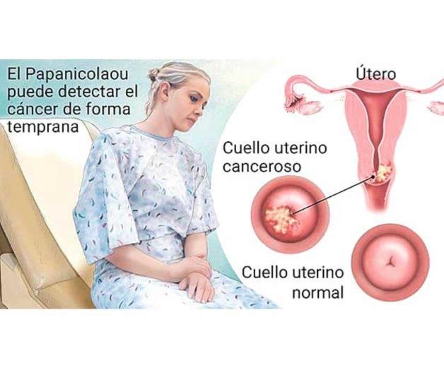 Incrementan casos de c&aacute;ncer cervicouterino