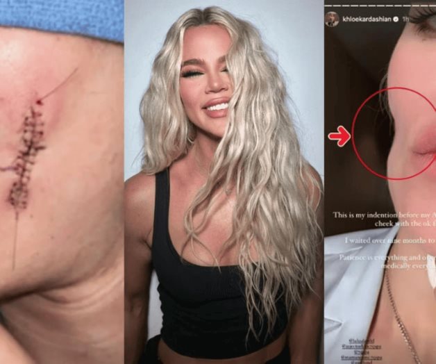 Cáncer de piel dejó una hendidura en la mejilla de Khloé Kardashian