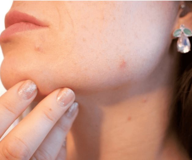 El tratamiento contra el acné que usa bacterias para combatirlo