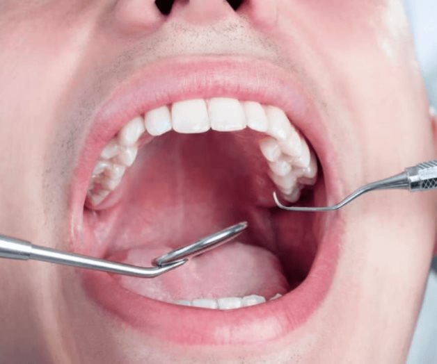 Todo lo que necesitas saber sobre las enfermedades bucales