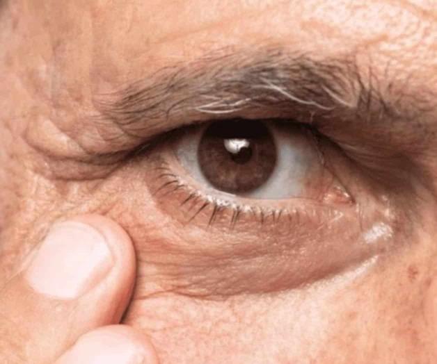 ¿Cómo tratar los distintos tipos de ojeras?