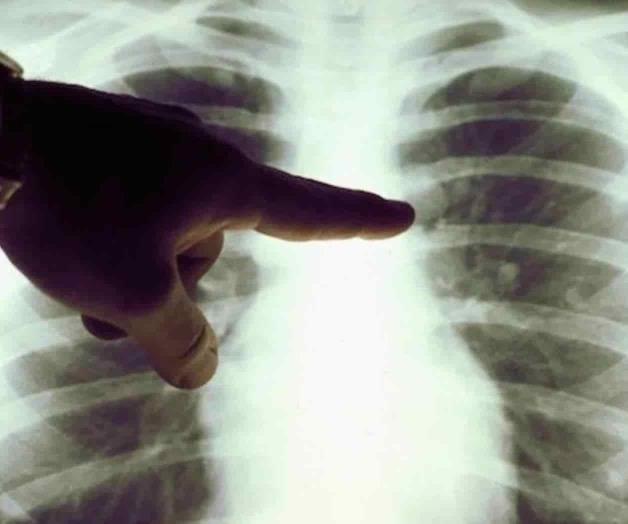 ¿Cuáles son los síntomas de la neumonía? ¿Cuáles son los síntomas de la neumonía?