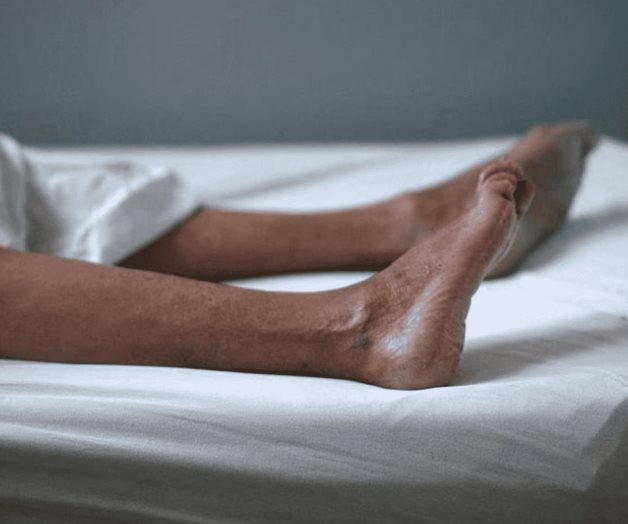 Suman 3 personas muertas por Síndrome de Guillain-Barré en Tlaxcala