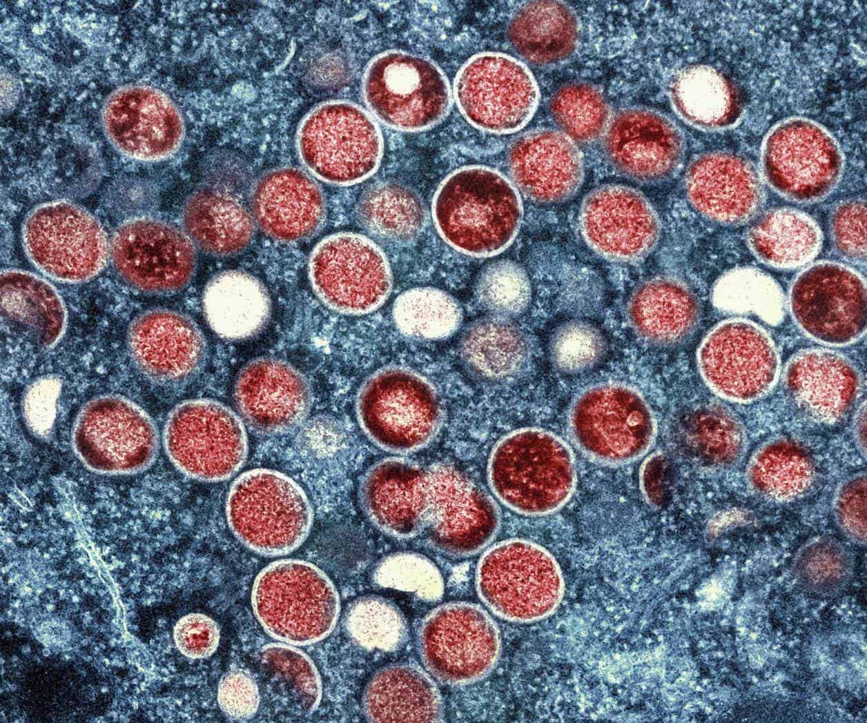 OMS declara emergencia global por brote de viruela símica en África