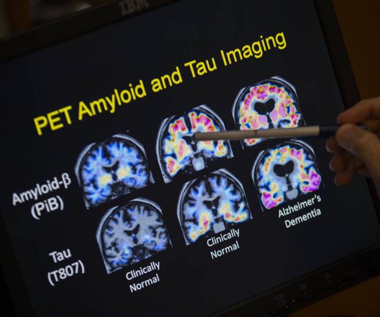 Aprobación de Leqembi para tratar Alzheimer en Reino Unido