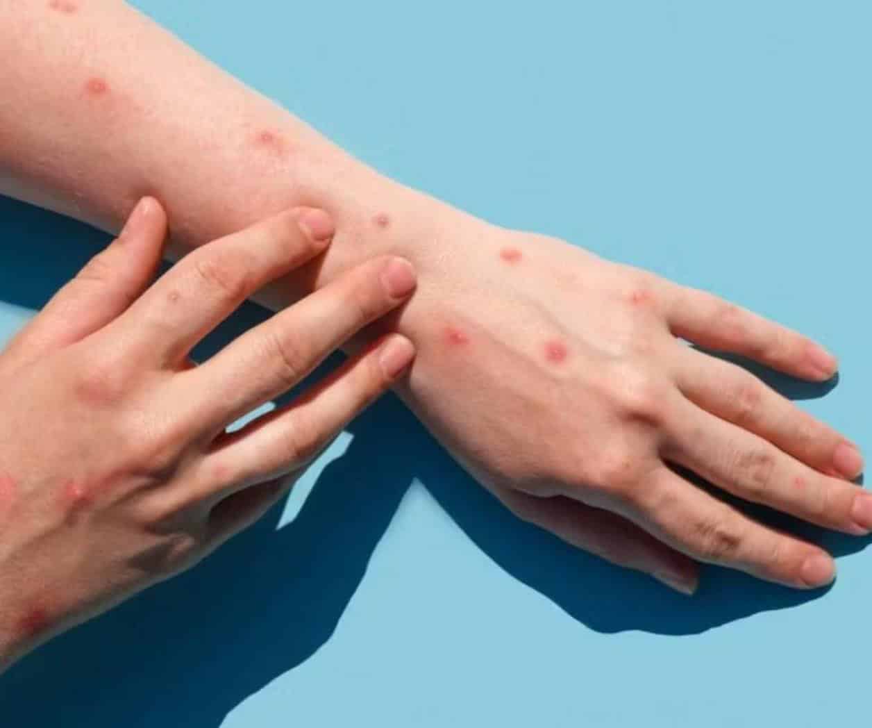 Aplican cercos sanitarios contra la viruela símica en Reynosa Aplican cercos sanitarios contra la viruela símica en Reynosa