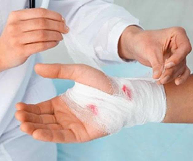 Dará Cruz Roja taller sobre el manejo de quemaduras