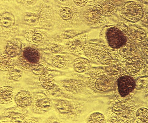 Drástica desaceleración de sífilis y gonorrea