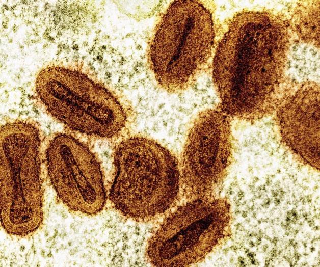 Confirmado caso de viruela símica en Estados Unidos Confirmado caso de viruela símica en Estados Unidos
