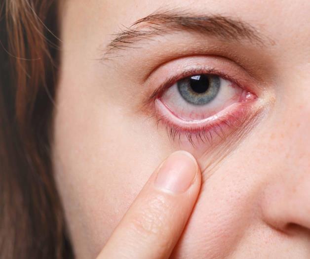 Preocupa alta incidencia de conjuntivitis