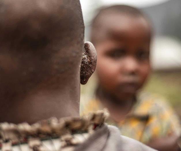Registran siete casos de Mpox