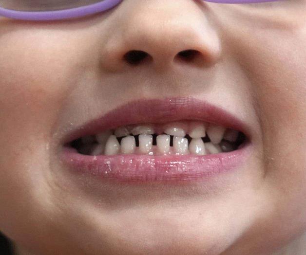 Proyecta Salud eliminar suplementos de fluoruro Proyecta Salud eliminar suplementos de fluoruro