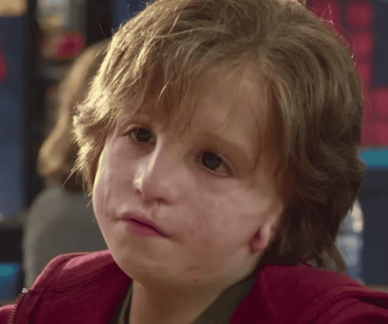 ¿Qué es el síndrome de Treacher Collins? Estos son sus síntomas