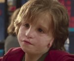 ¿Qué es el síndrome de Treacher Collins? Estos son sus síntomas