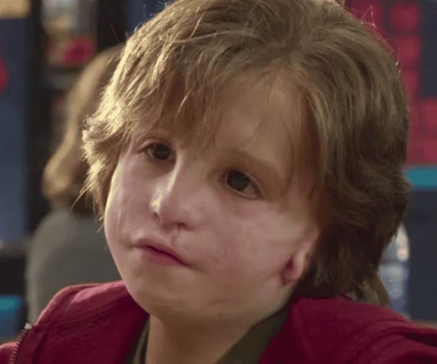 ¿Qué es el síndrome de Treacher Collins? Estos son sus síntomas ¿Qué es el síndrome de Treacher Collins? Estos son sus síntomas