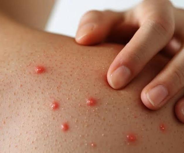 Descartan sarampi&oacute;n en el estado