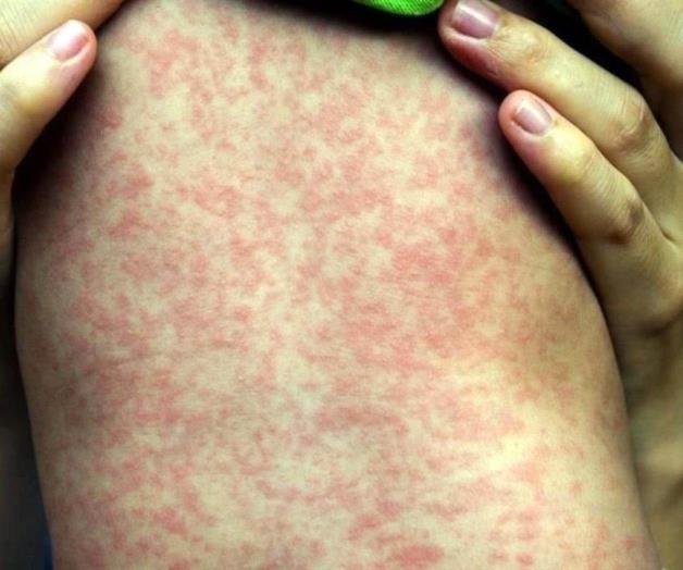 Suman 12 muertes por brote de sarampión