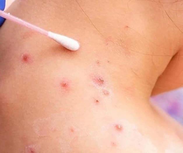Suben contagios de viruela s&iacute;mica en Tamaulipas