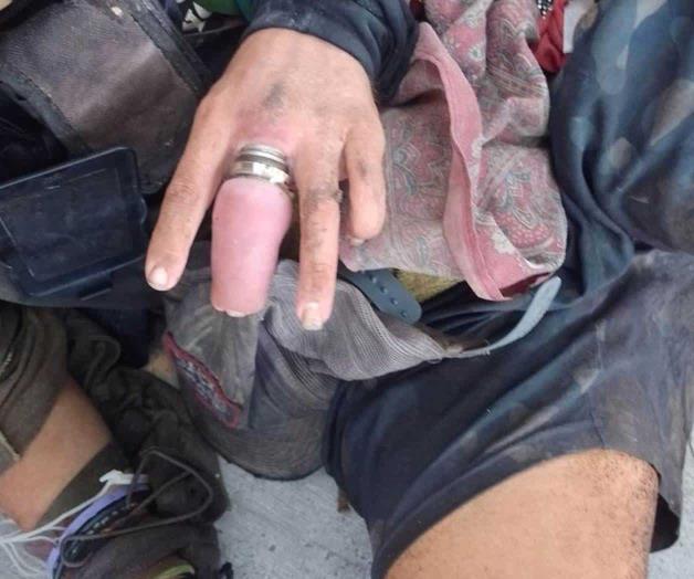 Podr&iacute;a perder un dedo joven con discapacidad